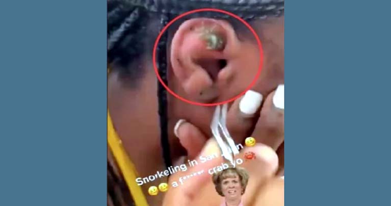 কানের মধ্যে জীবন্ত কাঁকড়া, ভিডিও ভাইরাল